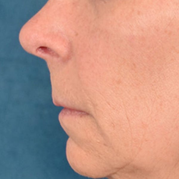 Lip Lift Before & After Gallery - Patient 358768 - Image 9