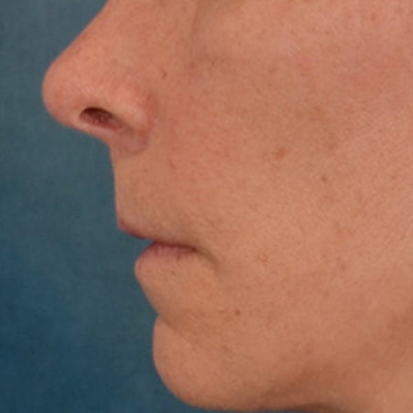 Lip Lift Before & After Gallery - Patient 358768 - Image 10