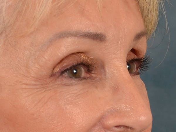 Eyelid Lift Before & After Gallery - Patient 247236 - Image 4