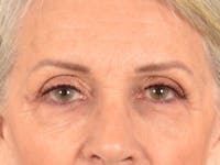Eyelid Lift Before & After Gallery - Patient 247236 - Image 1