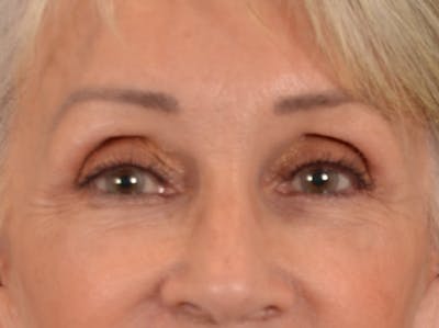Eyelid Lift Before & After Gallery - Patient 247236 - Image 2