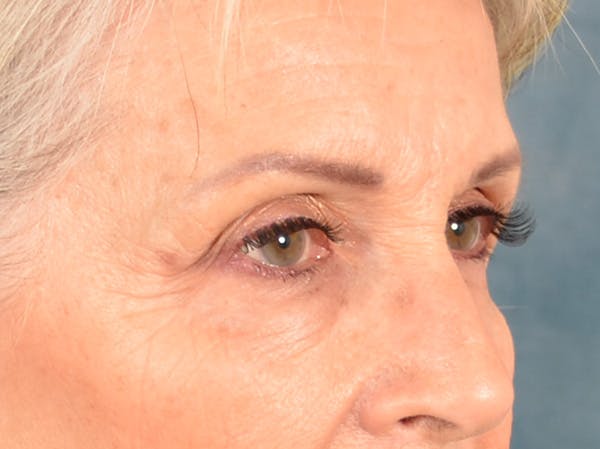 Eyelid Lift Before & After Gallery - Patient 247236 - Image 3