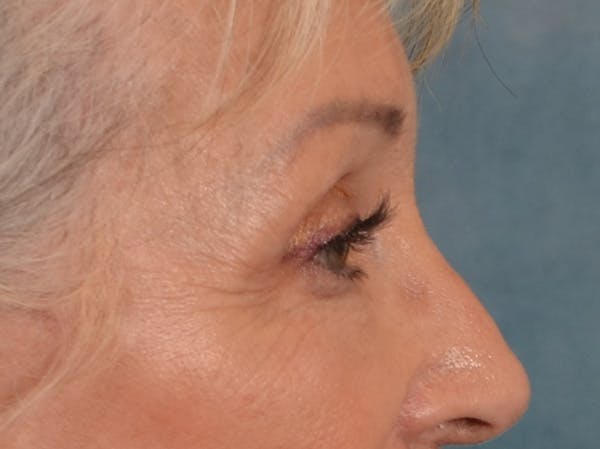 Eyelid Lift Before & After Gallery - Patient 247236 - Image 6