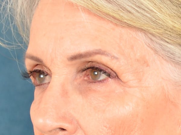 Eyelid Lift Before & After Gallery - Patient 247236 - Image 7