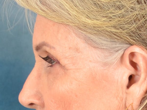Eyelid Lift Before & After Gallery - Patient 247236 - Image 9