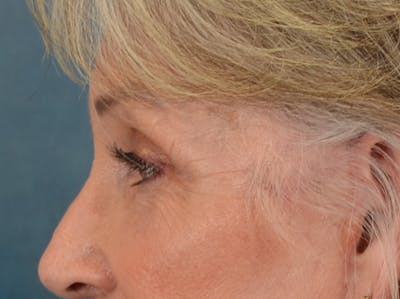 Eyelid Lift Before & After Gallery - Patient 247236 - Image 10