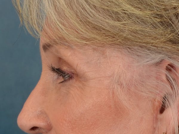 Eyelid Lift Before & After Gallery - Patient 247236 - Image 10
