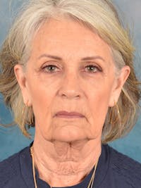Laser Skin Resurfacing Before & After Gallery - Patient 117753 - Image 1
