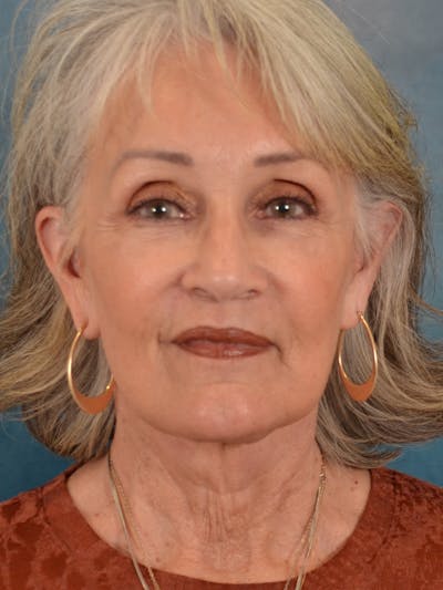 Laser Skin Resurfacing Before & After Gallery - Patient 117753 - Image 2