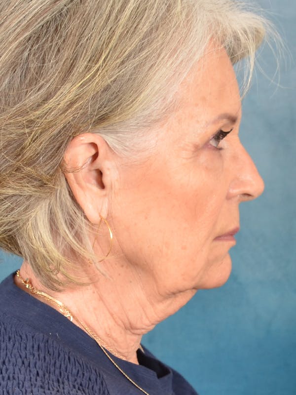 Laser Skin Resurfacing Before & After Gallery - Patient 117753 - Image 7