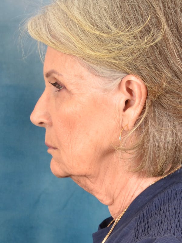 Laser Skin Resurfacing Before & After Gallery - Patient 117753 - Image 9