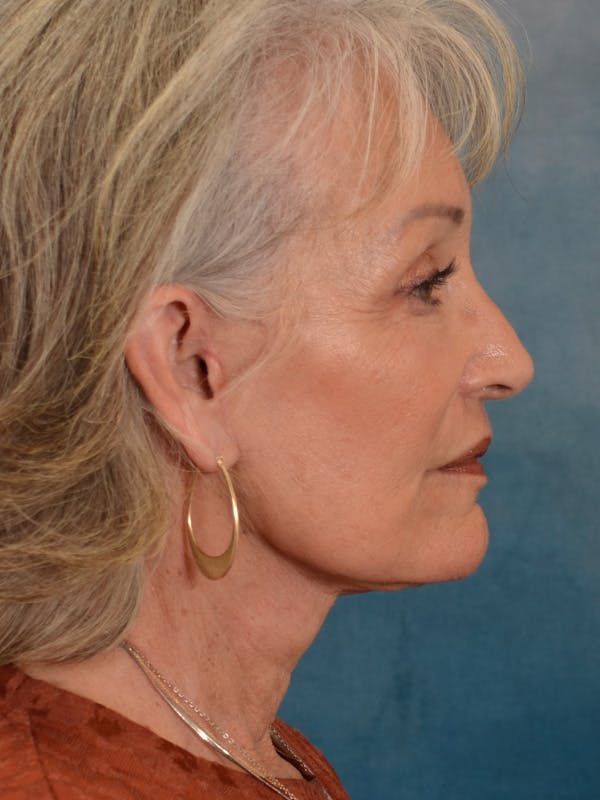Laser Skin Resurfacing Before & After Gallery - Patient 117753 - Image 8