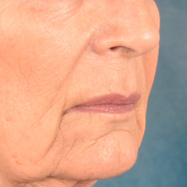 Lip Lift Before & After Gallery - Patient 322661 - Image 3