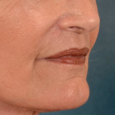 Lip Lift Before & After Gallery - Patient 322661 - Image 4