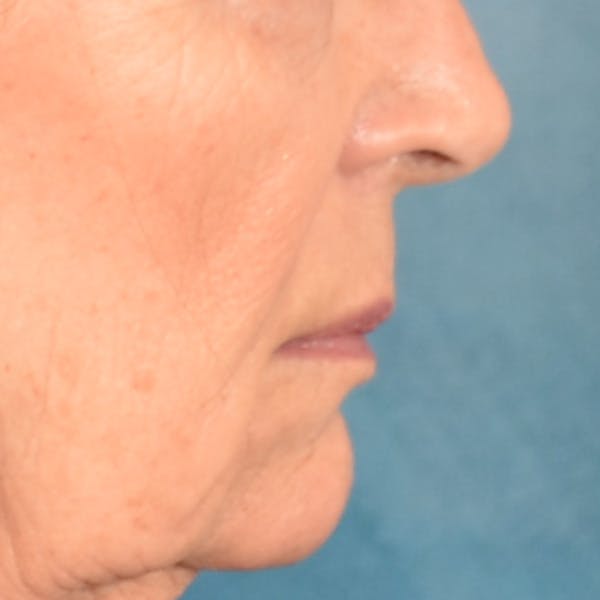 Lip Lift Before & After Gallery - Patient 322661 - Image 5