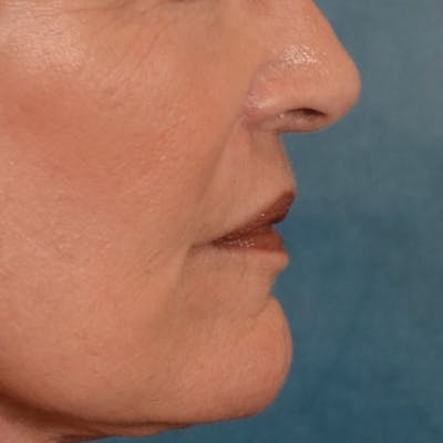 Lip Lift Before & After Gallery - Patient 322661 - Image 6