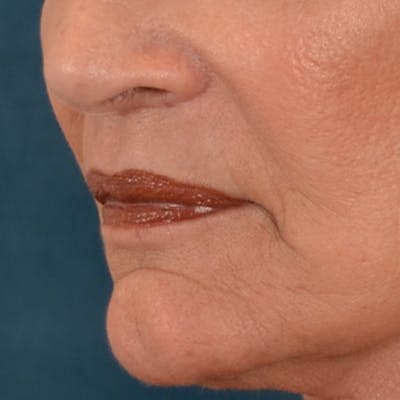 Lip Lift Before & After Gallery - Patient 322661 - Image 8