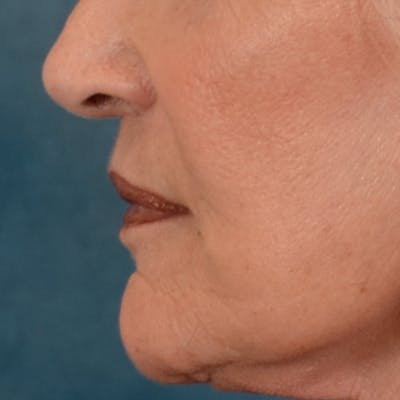 Lip Lift Before & After Gallery - Patient 322661 - Image 10