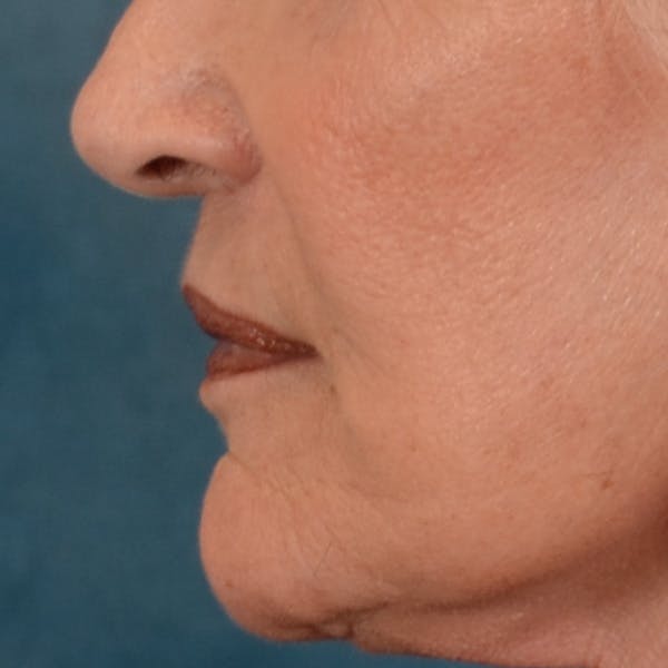 Lip Lift Before & After Gallery - Patient 322661 - Image 10
