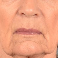 Lip Lift Before & After Gallery - Patient 322661 - Image 1
