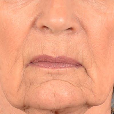 Lip Lift Before & After Gallery - Patient 322661 - Image 1