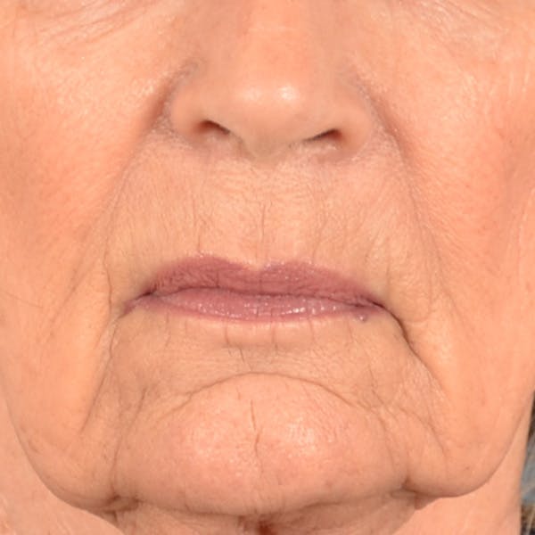 Lip Lift Before & After Gallery - Patient 322661 - Image 1