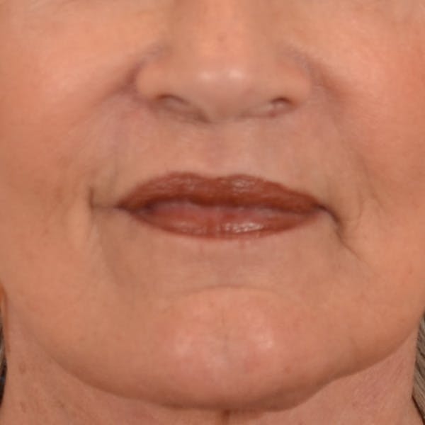 Lip Lift Before & After Gallery - Patient 322661 - Image 2