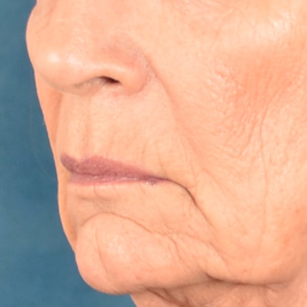 Lip Lift Before & After Gallery - Patient 322661 - Image 7