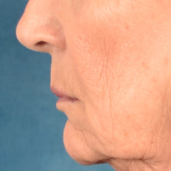 Lip Lift Before & After Gallery - Patient 322661 - Image 9