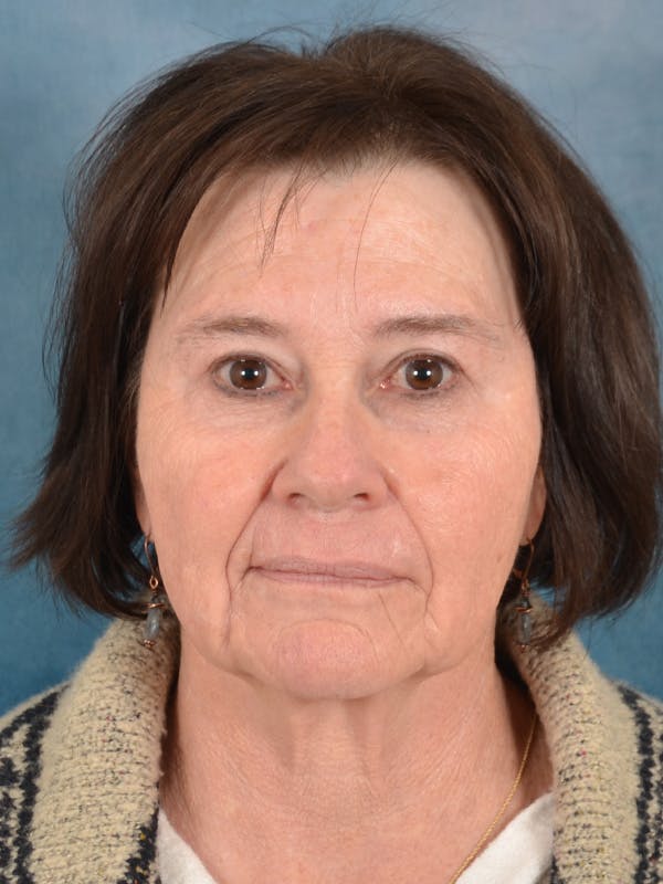 Brow Lift Before & After Gallery - Patient 412841 - Image 3