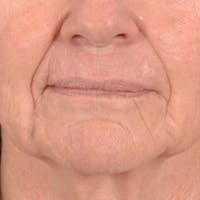 Lip Lift Before & After Gallery - Patient 106589 - Image 1