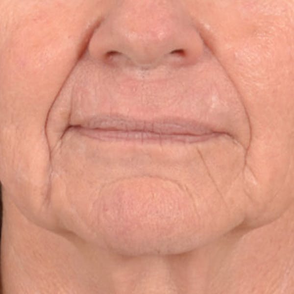 Lip Lift Before & After Gallery - Patient 106589 - Image 1