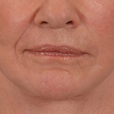 Lip Lift Before & After Gallery - Patient 106589 - Image 2