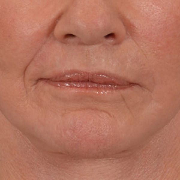 Lip Lift Before & After Gallery - Patient 106589 - Image 2
