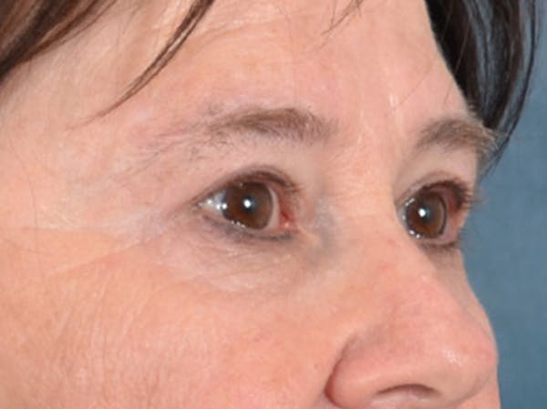 Eyelid Lift Before & After Gallery - Patient 586331 - Image 3