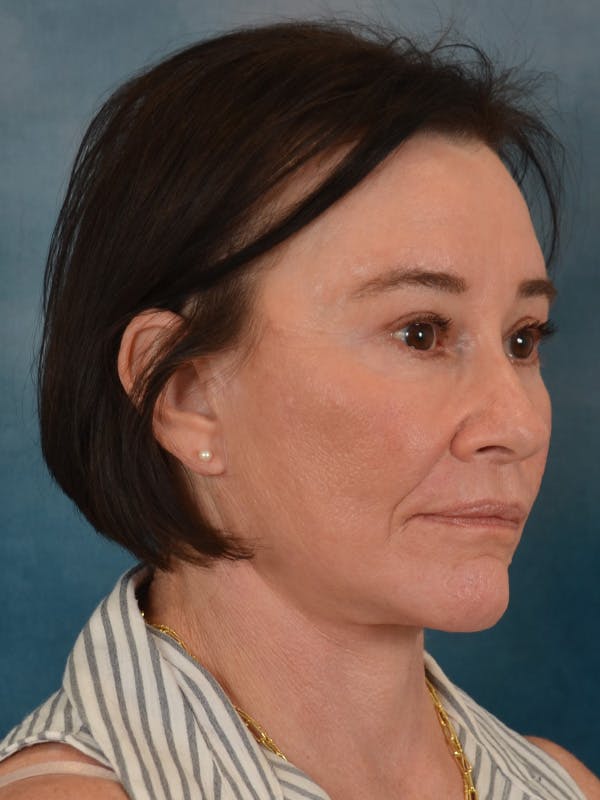 Brow Lift Before & After Gallery - Patient 412841 - Image 6