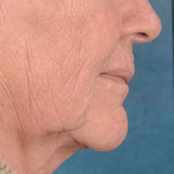 Lip Lift Before & After Gallery - Patient 106589 - Image 7