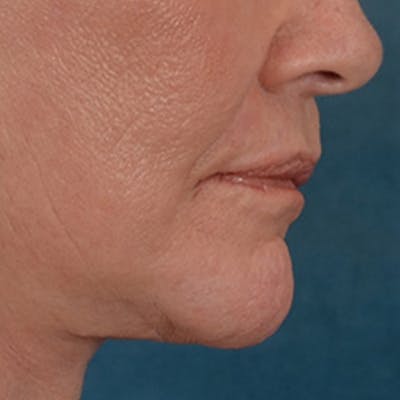Lip Lift Before & After Gallery - Patient 106589 - Image 8
