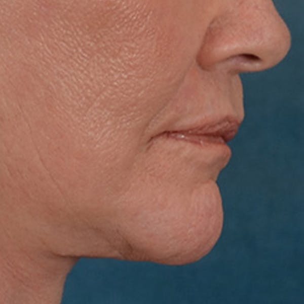 Lip Lift Before & After Gallery - Patient 106589 - Image 8