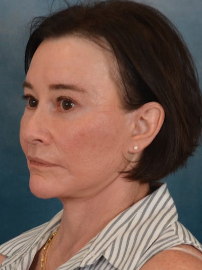 Earlobe Repair Before & After Gallery - Patient 708603 - Image 2