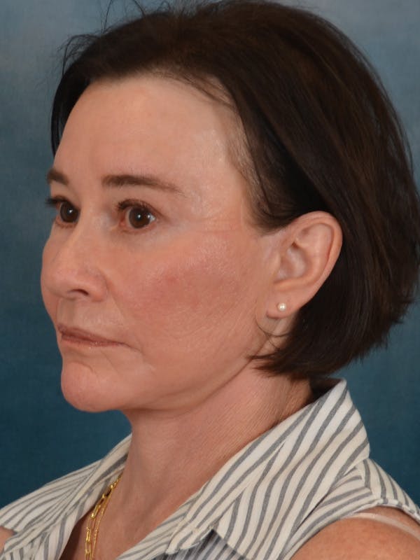 Brow Lift Before & After Gallery - Patient 412841 - Image 2
