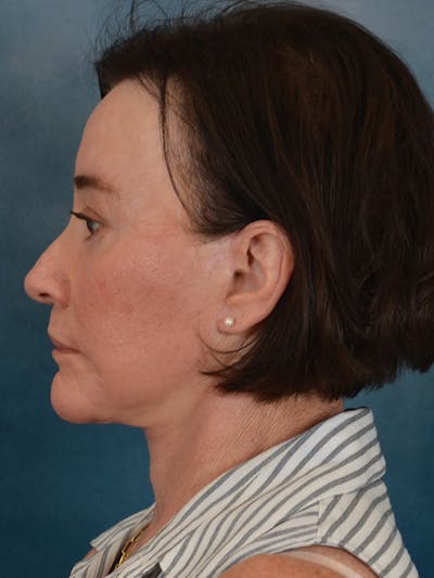 Lip Lift Before & After Gallery - Patient 106589 - Image 10