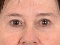 Eyelid Lift Before & After Gallery - Patient 586331 - Image 1