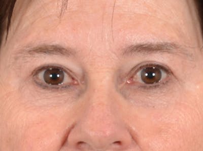 Eyelid Lift Before & After Gallery - Patient 586331 - Image 1