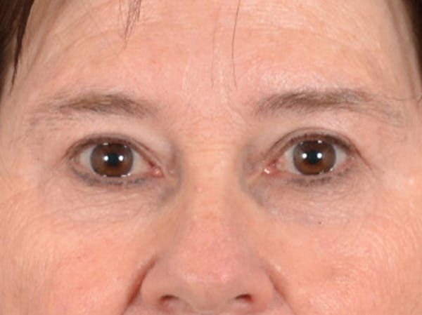 Eyelid Lift Before & After Gallery - Patient 586331 - Image 1