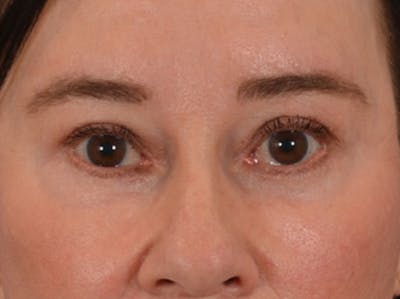Eyelid Lift Before & After Gallery - Patient 586331 - Image 2