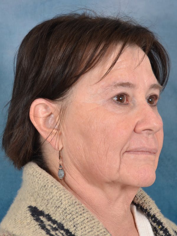 Brow Lift Before & After Gallery - Patient 412841 - Image 5