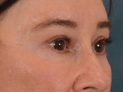 Eyelid Lift Before & After Gallery - Patient 586331 - Image 4