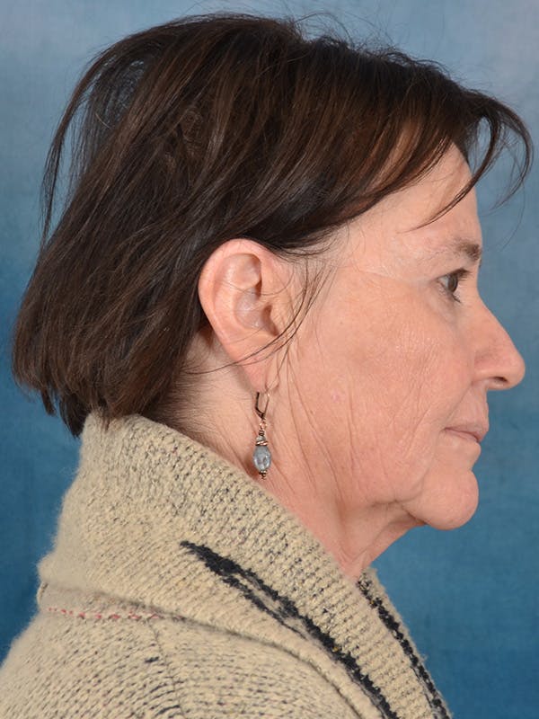 Brow Lift Before & After Gallery - Patient 412841 - Image 7