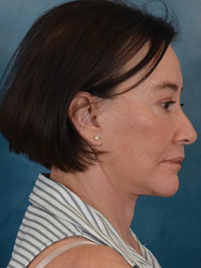 Brow Lift Before & After Gallery - Patient 412841 - Image 8